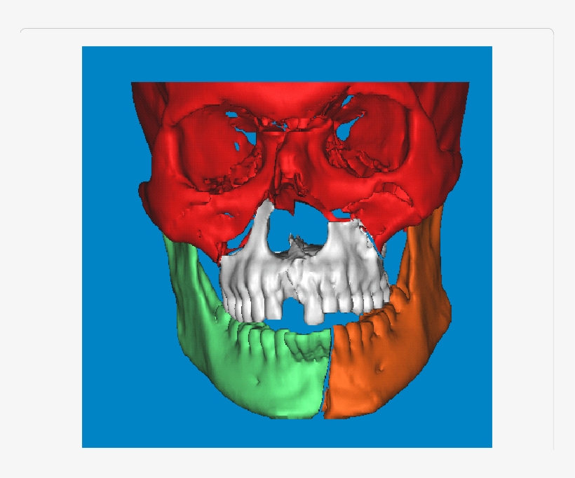 D Cad Model Of The Patient - Computer-aided Design, transparent png