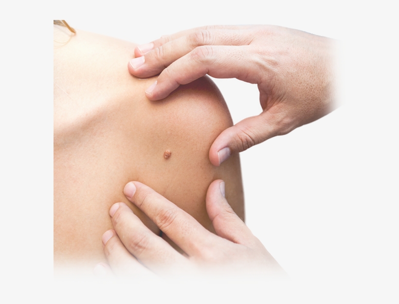 Home Page Slideshow Mole - Washington Manual Of Dermatology Diagnostics [book], transparent png