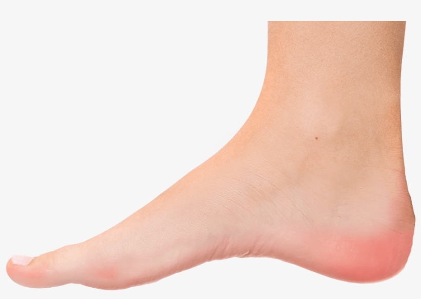 Milwaukee Plantar Fasciitis Foot - Transparent Foot Png, transparent png