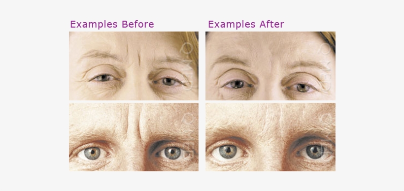 Botox New - Botox Before And After, transparent png