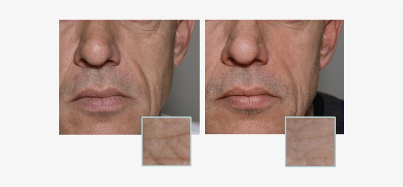 Anti Wrinkle Brisbane - Wrinkle, transparent png
