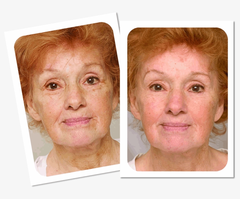 Before And After Laser Anti-wrinkle Treatment - Collage, transparent png