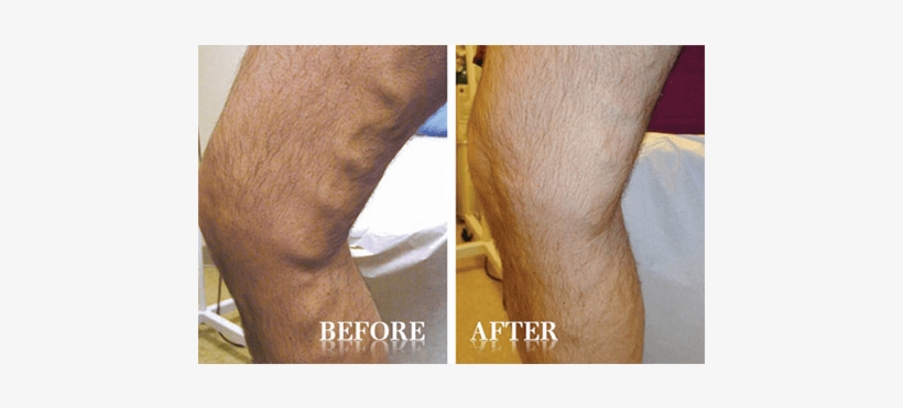 Advanced Vein & Laser Center Contents Gallery Vein - Horse Chestnut Varicose Veins Before And After, transparent png