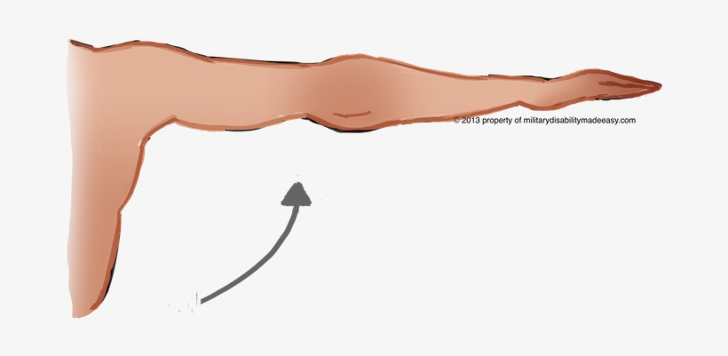 Shoulder Muscle 6 - Arm Atrophy, transparent png