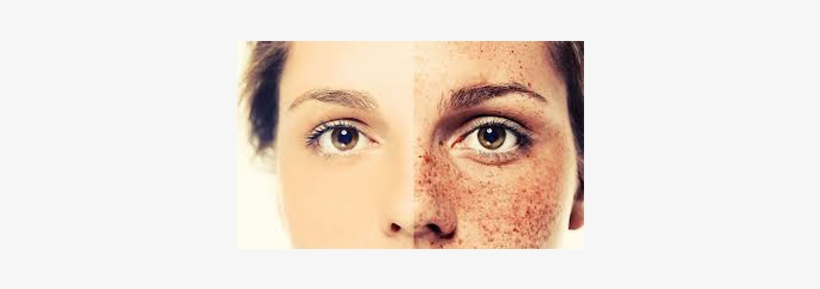Freckles Are Skin Cells That Contain A Pigment Called - Yüzdeki Çiller Nasıl Geçer, transparent png