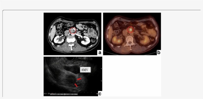 Radiological And Endoscopic Ultrasonographic Findings - Computed Tomography, transparent png