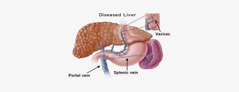 Gastroesophageal Varices Icd 10, transparent png