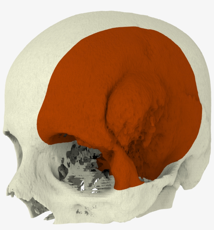 Together With The Surgeon Our Biomedical Engineers - Meningioma, transparent png