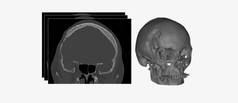 Ct-scan Segmentation & 3d Reconstruction - Ct Scan Transparent, transparent png