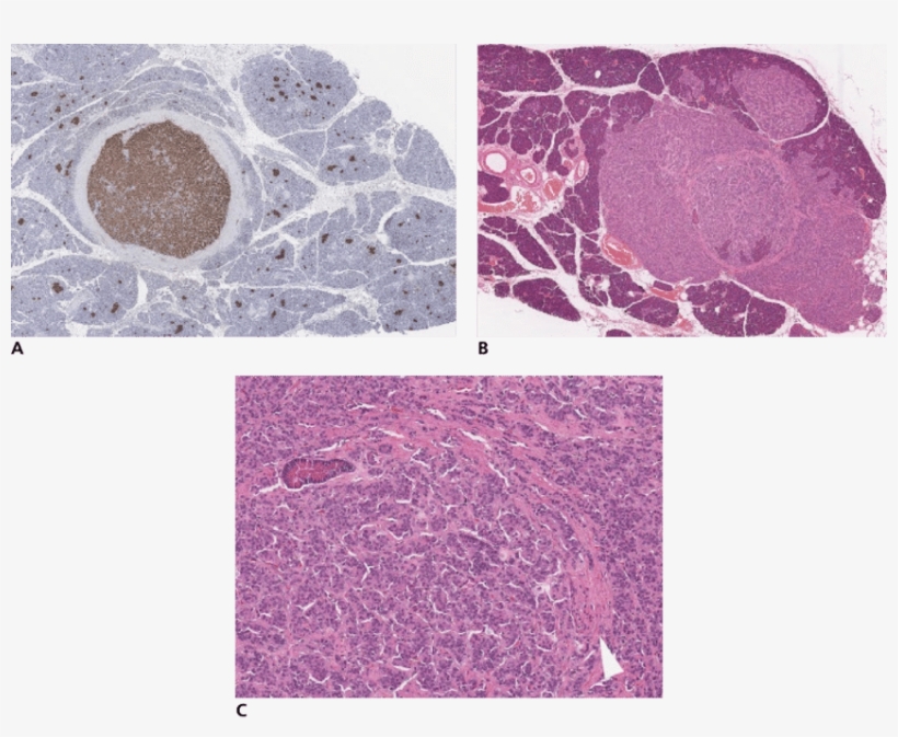 37 Beta Cell Tumors, Ferret - Abcès En Bouton De Chemise, transparent png