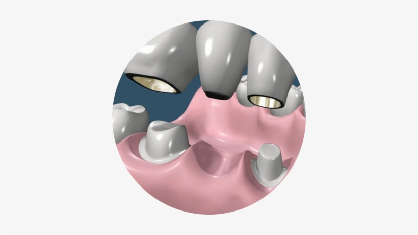 Coronas Y Puentes - Prostodoncia Odontologia, transparent png