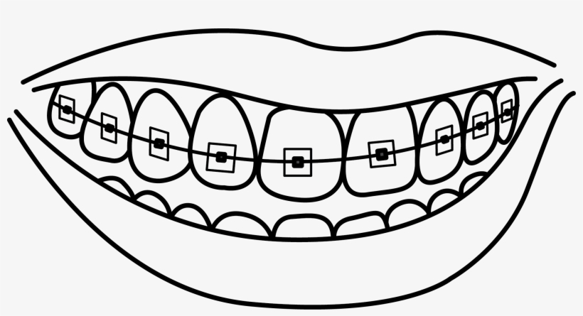 Clip Transparent Download Braces At Getdrawings Com - Teeth With Braces Drawing, transparent png