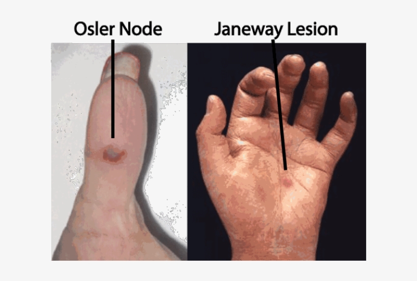 Janeway And Osler Janeway Lesions And Osler's Nodes 620x479 PNG