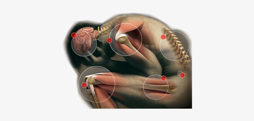 Its Effectiveness To Reduce Acupuncture For Pain - Somatization Disorder, transparent png
