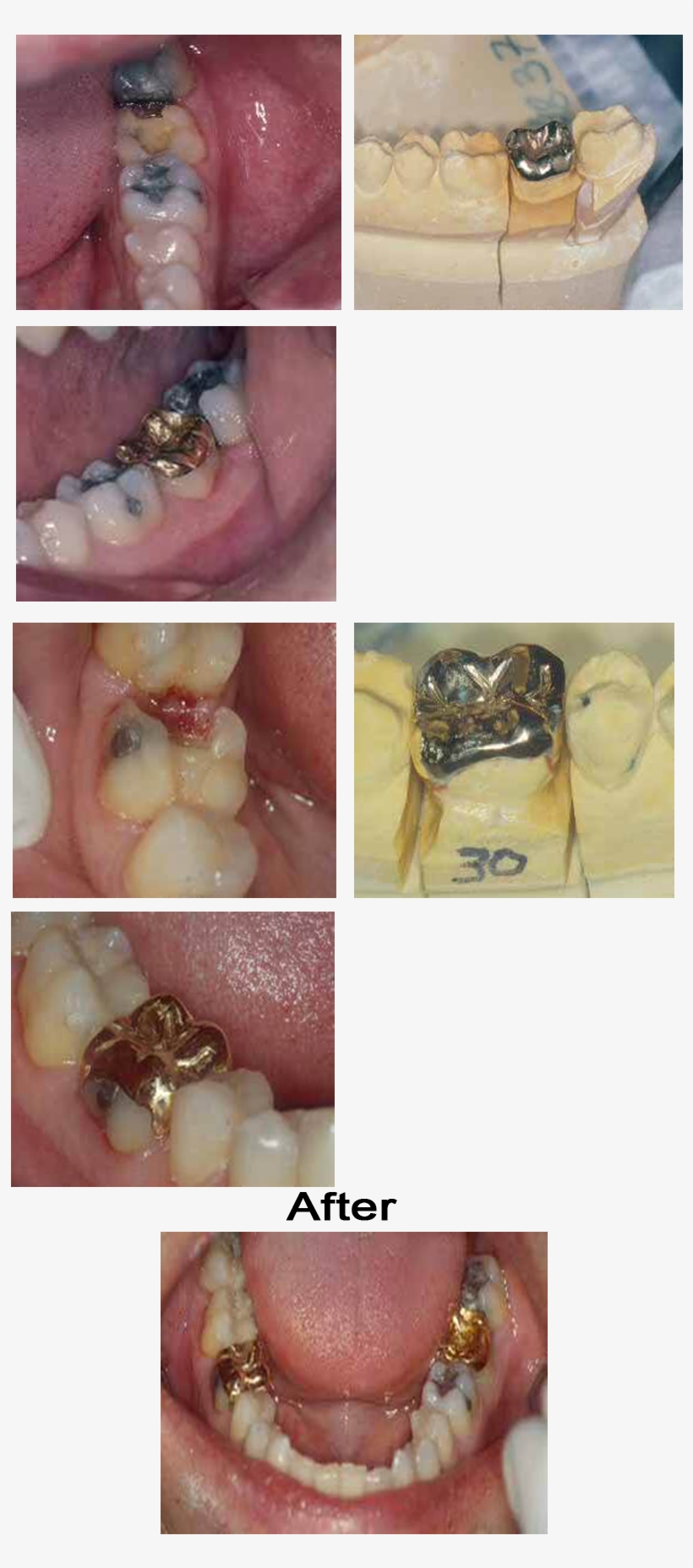 In This Case Two Gold Onlays Were Cast For The - Washington, D.c., transparent png