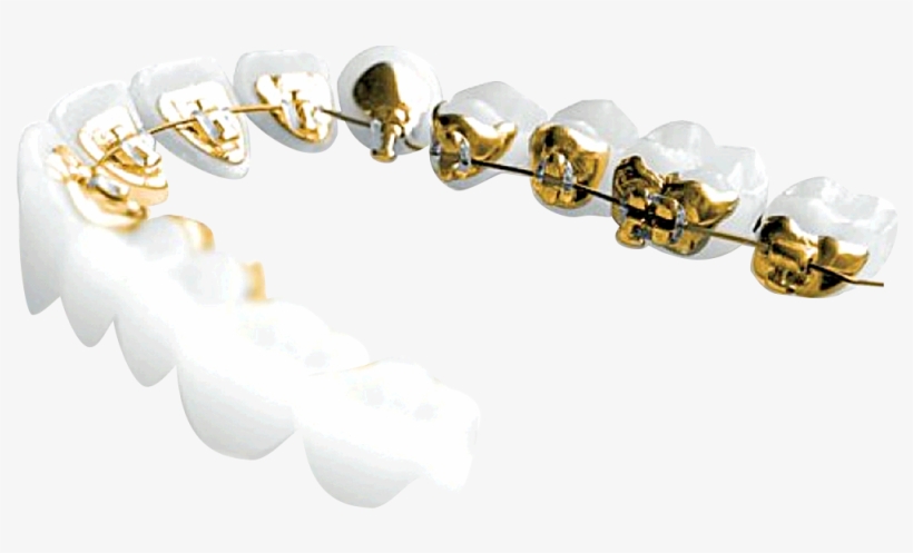 100% Customized And 100% Hidden, Incognito™ Braces - Incognito Braces Png, transparent png