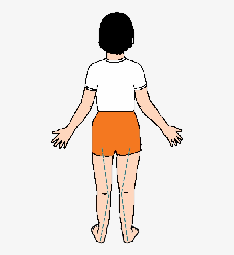 "over Pronation" Means That, As Your Child Walks They - Illustration, transparent png