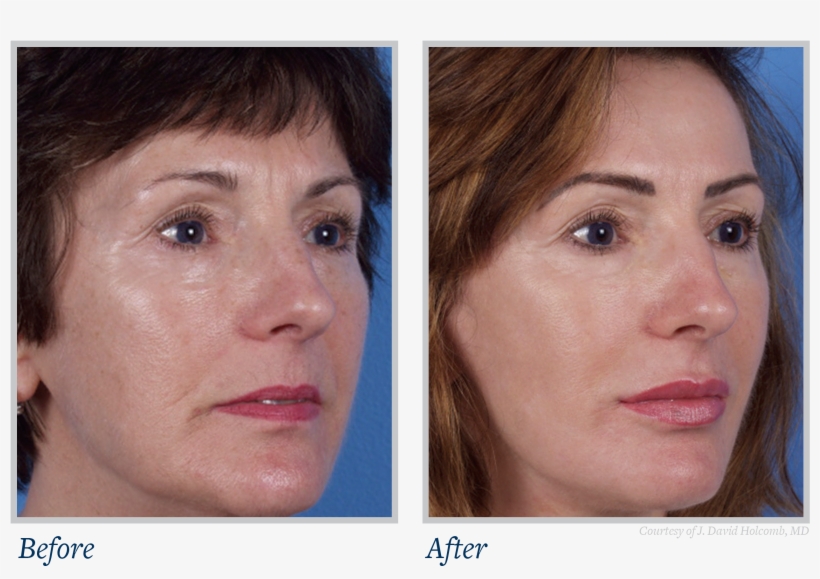 Now Available To The General Public - Skin Texture Before And After, transparent png