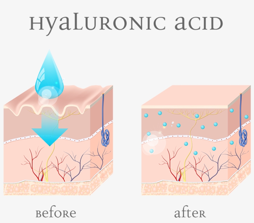 Illustration Of Before And After-effects Of Hyaluronic - Injectable Filler, transparent png