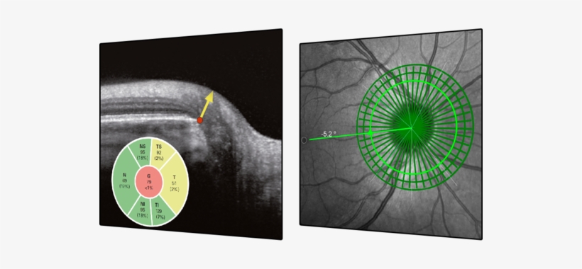 Glaucoma Module Premium Edition - Glaucoma, transparent png
