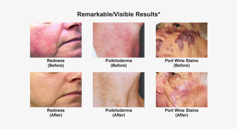 *these Results Were Obtained After Multiple Treatments - Vbeam Laser, transparent png