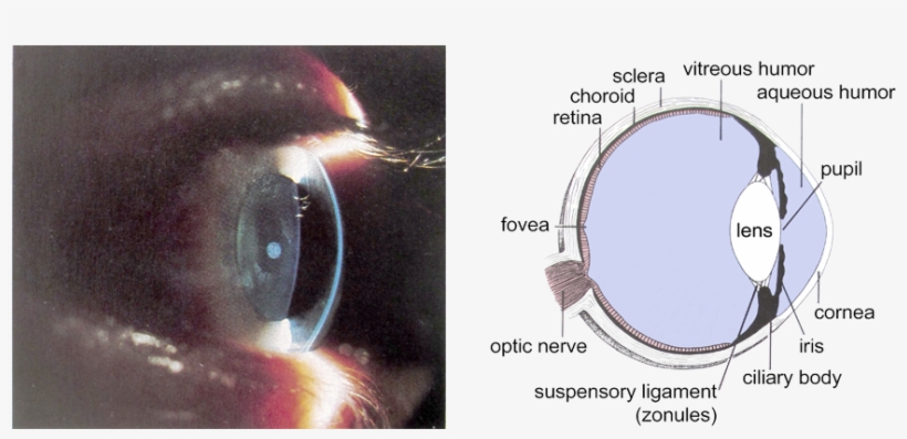 קטרקט - Human Eye, transparent png