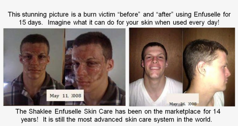 Shaklee Enfuselle - “ - Burn Skin Care Before And After, transparent png