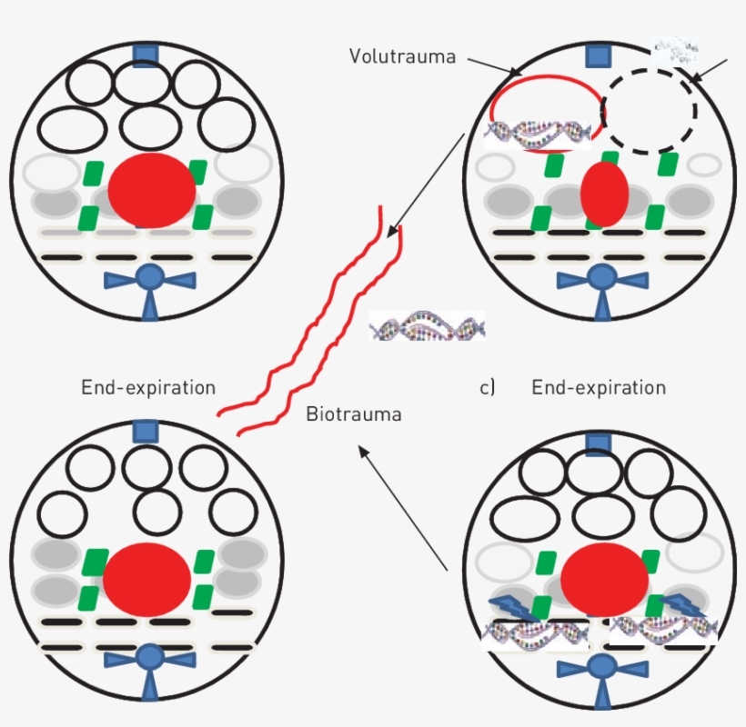 A) The Distribution Of Normally Aerated (white Circles), - Prone Ventilation, transparent png