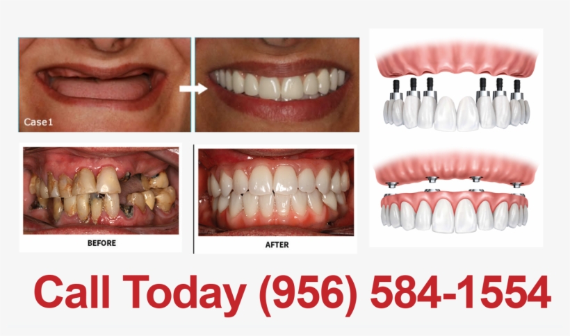 New Smile In 1 Day - New Smile Dental, transparent png