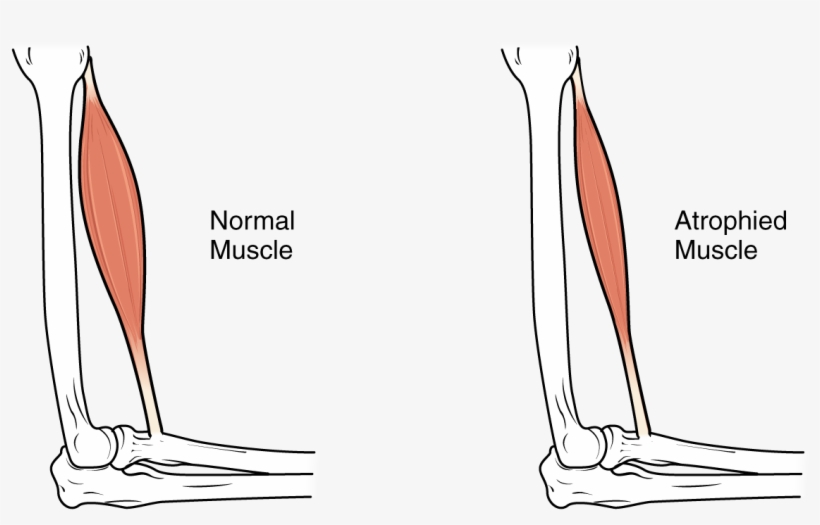 This Image Shows Muscle Atrophy - Muscle Atrophy, transparent png