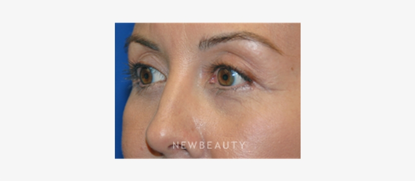 Dr Martin Otoole Blepharoplasty B - Blepharoplasty, transparent png