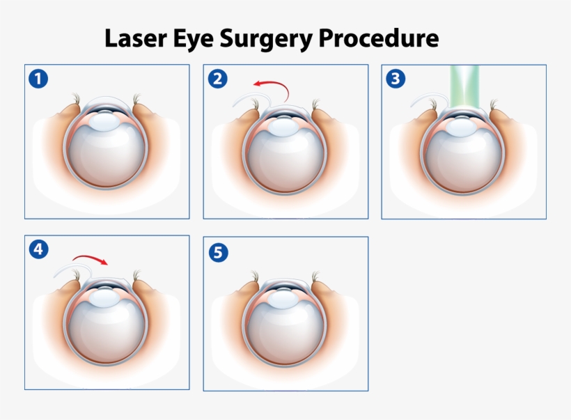 Laser Eye Surgery Procedure, transparent png