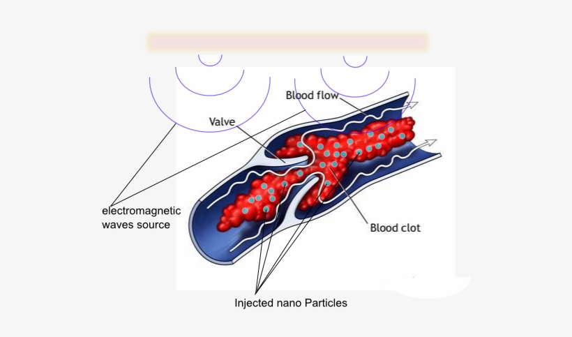 Removing Blood Clots Using Nano-particles - Blood Clot, transparent png