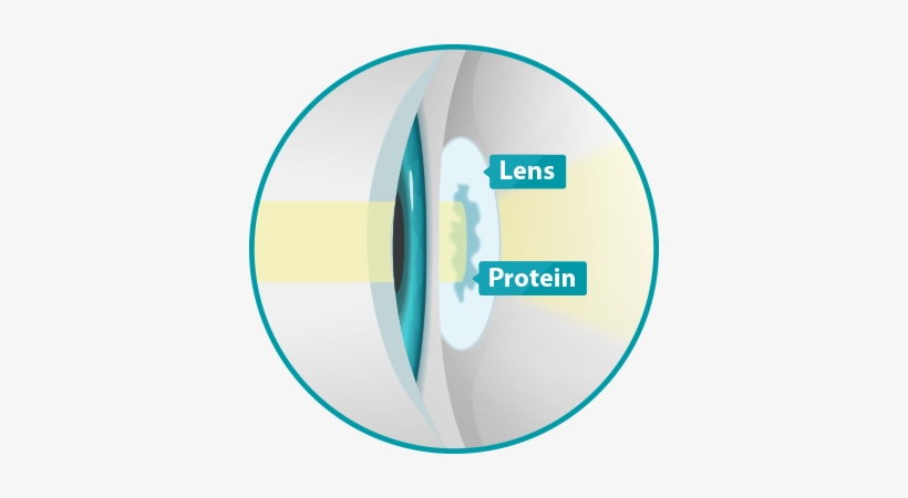 Cataracts Occur When The Lens In Your Eye Becomes Cloudy - Colorado, transparent png