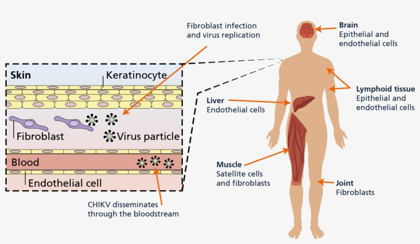 06 Pm 61359 Clinical Manifestation - Diagram, transparent png