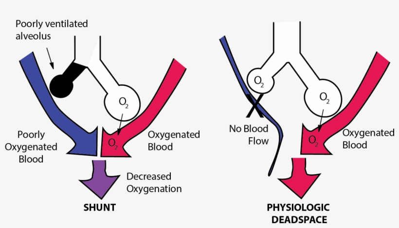 Ventilation Perfusion Mismatch - Pulmonary Shunt, transparent png