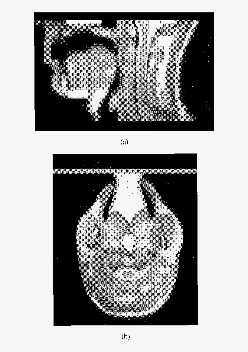 Method Of Terminating The Open Mouth To Contain The - Radiology, transparent png