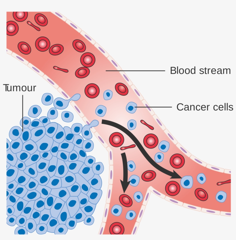 Diagram Showing Cancer Cells Spreading Into The Blood - Cancer Cells Spreading Through Body, transparent png