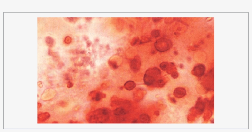 A Synovial Fluid Wet Smear Stained With Alizarin Red - Synovial Fluid Alizarin Red, transparent png