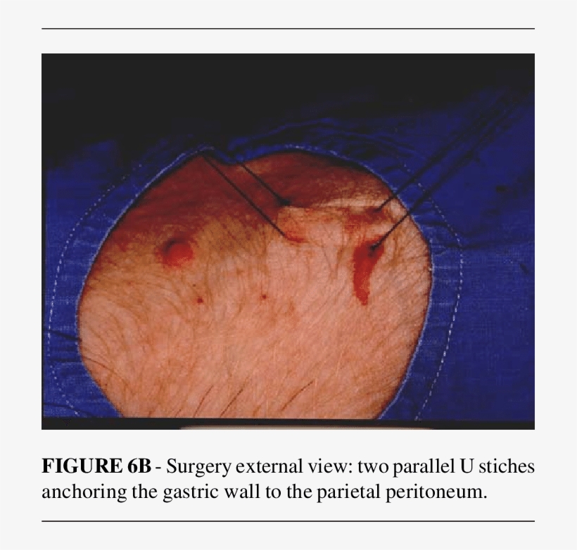 A-schematic Gastric View - Oftalmopatia Tiroidea, transparent png