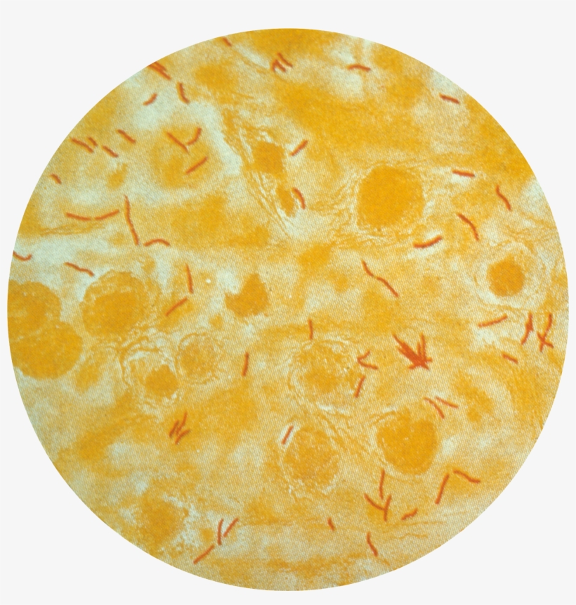 Tb In Sputum - Mycobacterium Tuberculosis, transparent png