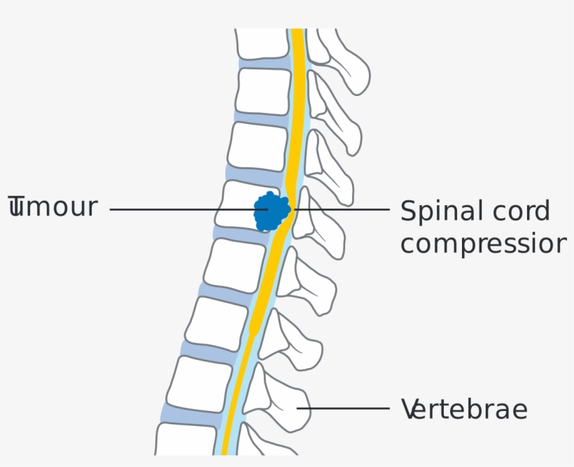 Define Spinal Cord Compression, transparent png