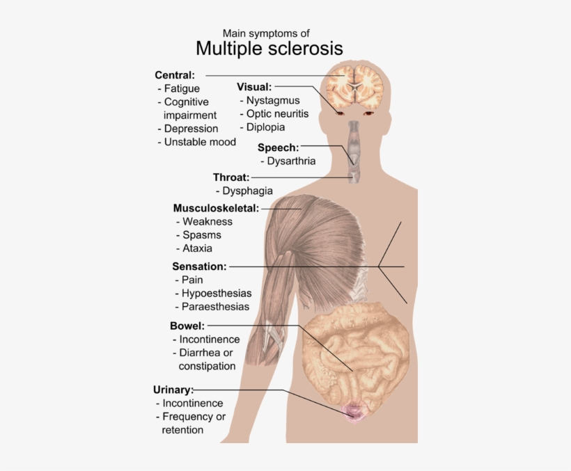 “main Symptoms Of Multiple Sclerosis - Multiple Sclerosis Symptoms, transparent png
