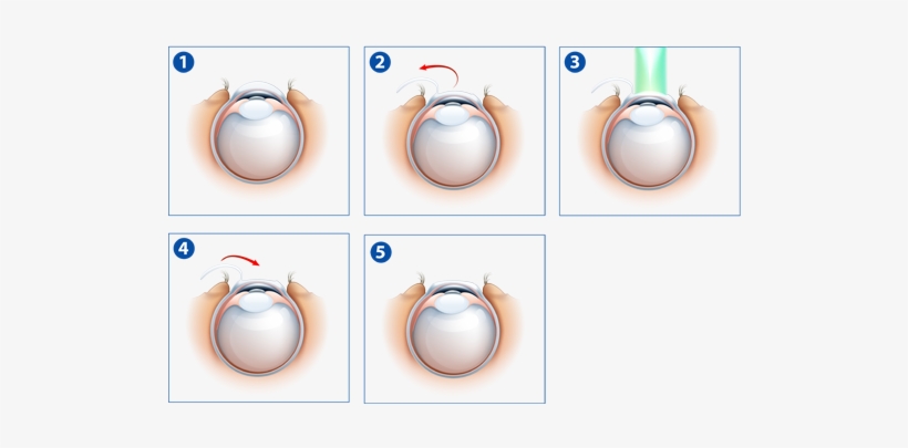 The Doctors At New Orleans Eye Specialists Have Performed - Laser Eye Surgery Procedure, transparent png