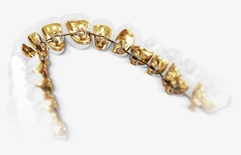 Lingual Braces Sydney - Incognito Braces, transparent png