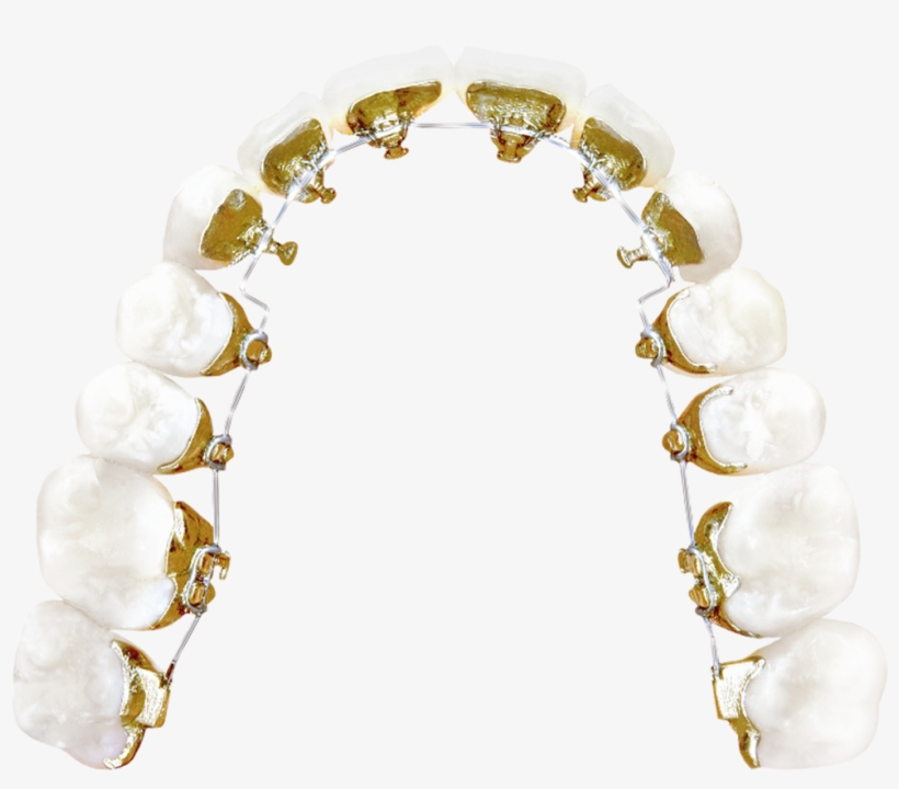 Lingual Braces - Incognito Lingual Braces Png, transparent png
