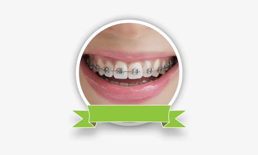Braces - Dental Braces, transparent png