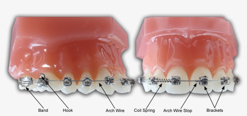 Images Braces Diagram - Philadelphia, transparent png