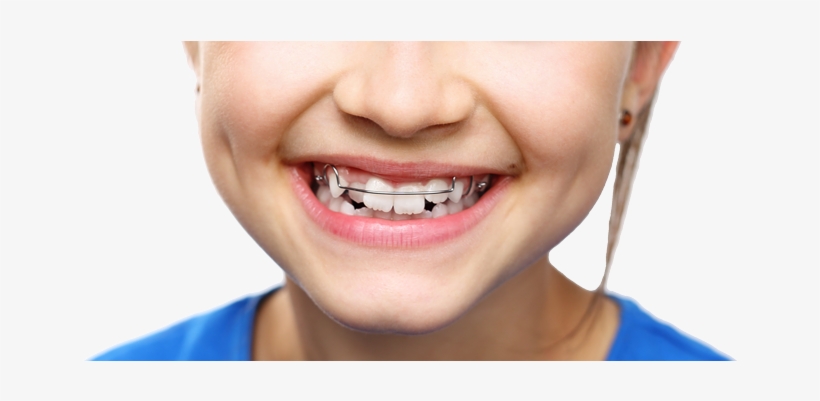 An Open Letter To Prospective Braces Users Everywhere - Phase I Orthodontic Treatment, transparent png