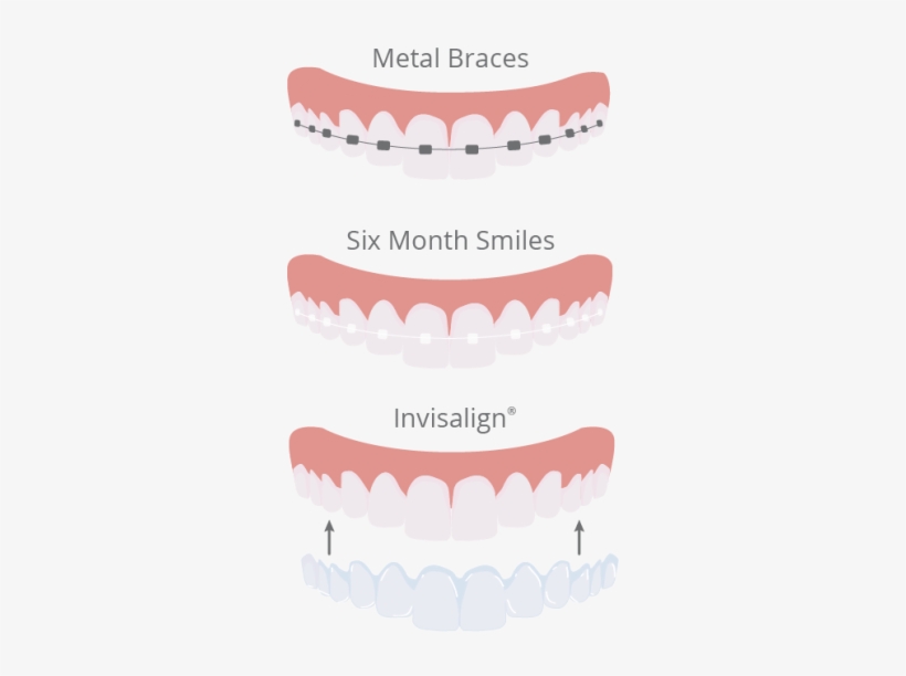 Teeth Straightening Illustration - Orthodontics, transparent png